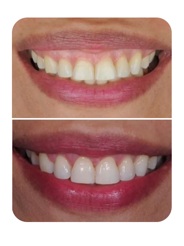 Resultado de correção de sorriso gengival — caso 5