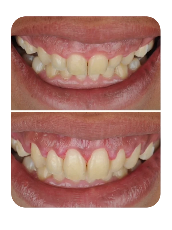 Resultado de correção de sorriso gengival — caso 3