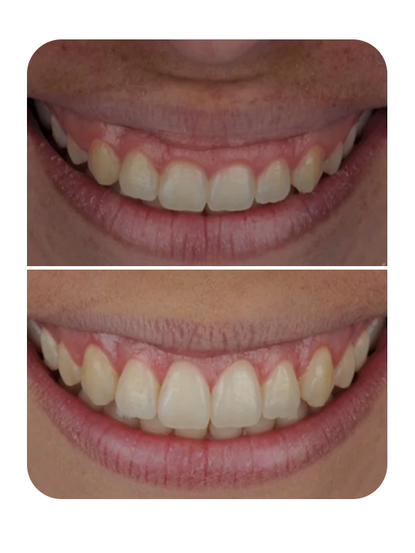 Resultado de correção de sorriso gengival — caso 2
