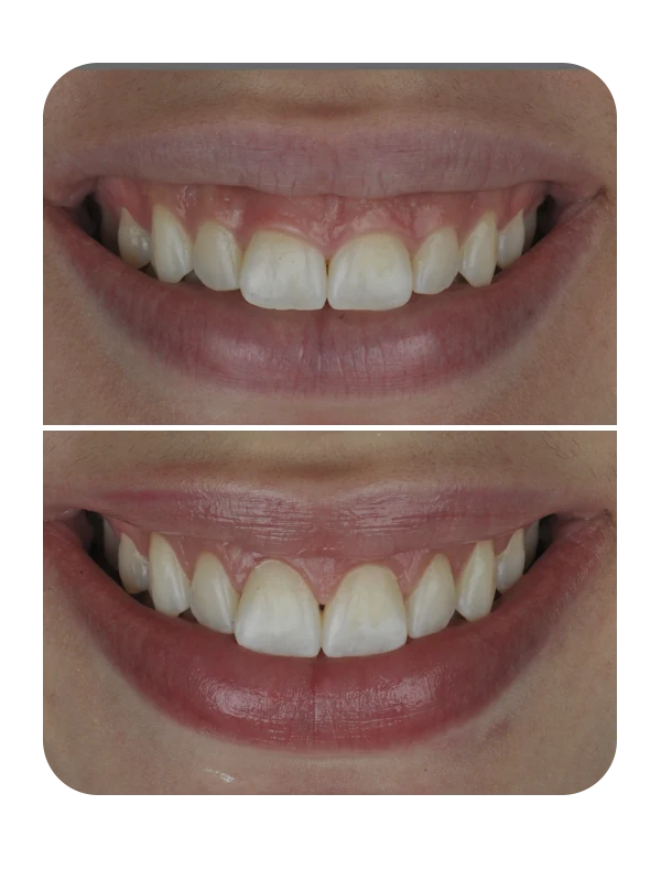 Resultado de correção de sorriso gengival — caso 4